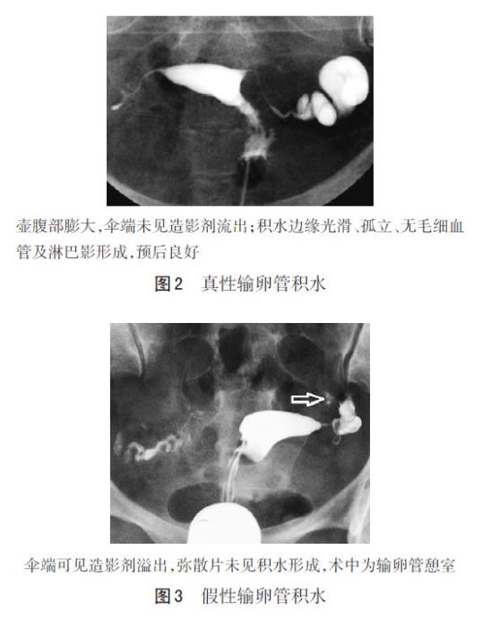 子宫输卵管造影的图像解读