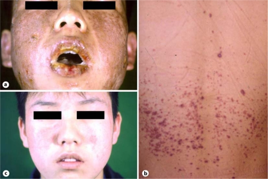 Minocin Acne Before And After