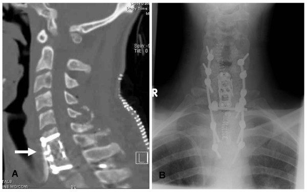 典病例_经典病例:原发性颈椎 非霍奇金淋巴瘤 _