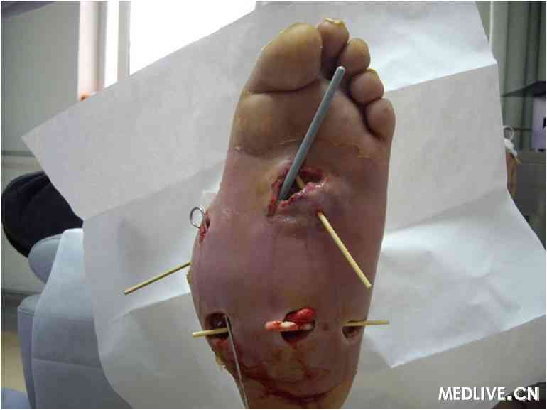 经典病例_从典型病例认识夏科氏关节病