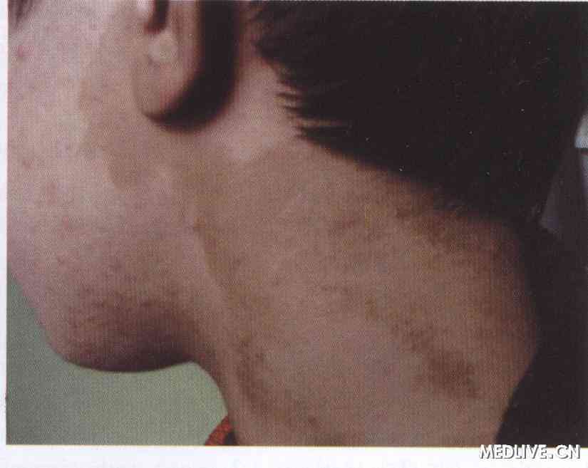 图1mccune-albright综合征患者颈部皮肤外观 像,可见典型的皮肤牛奶