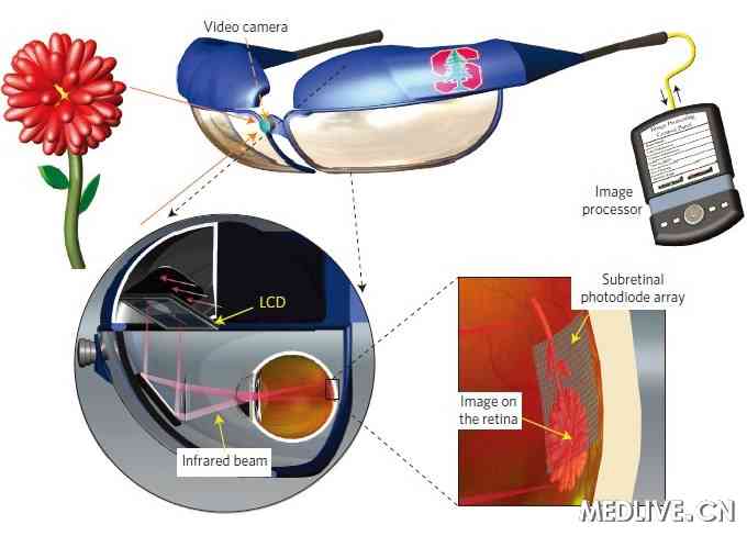 nature子刊:新型人工视网膜帮助盲人重见光明_