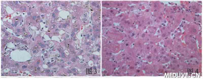 胡锡琪:药物性肝损伤组织病理学评分