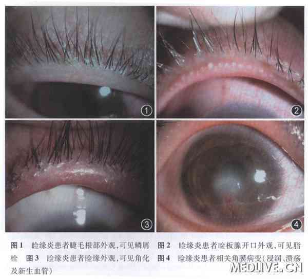 专家详解：睑缘炎及其相关角结膜病变_睑缘炎_角结膜