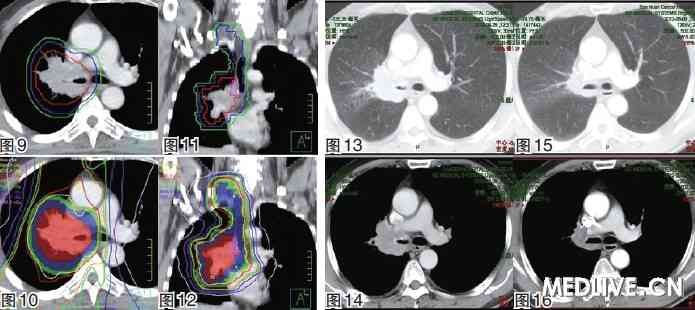 专家视点:非小细胞肺癌的放疗进展