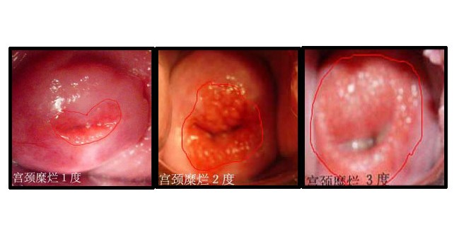 龚晓明解读宫颈糜烂为何已经过时_宫颈糜烂_