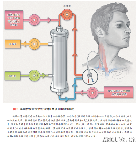 连续性肾替代疗法治疗急性肾脏损伤_急性肾脏