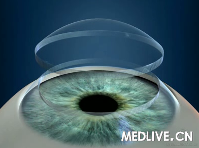 DSEK与PKP的3年比较_DSEK_PKP_角膜内皮
