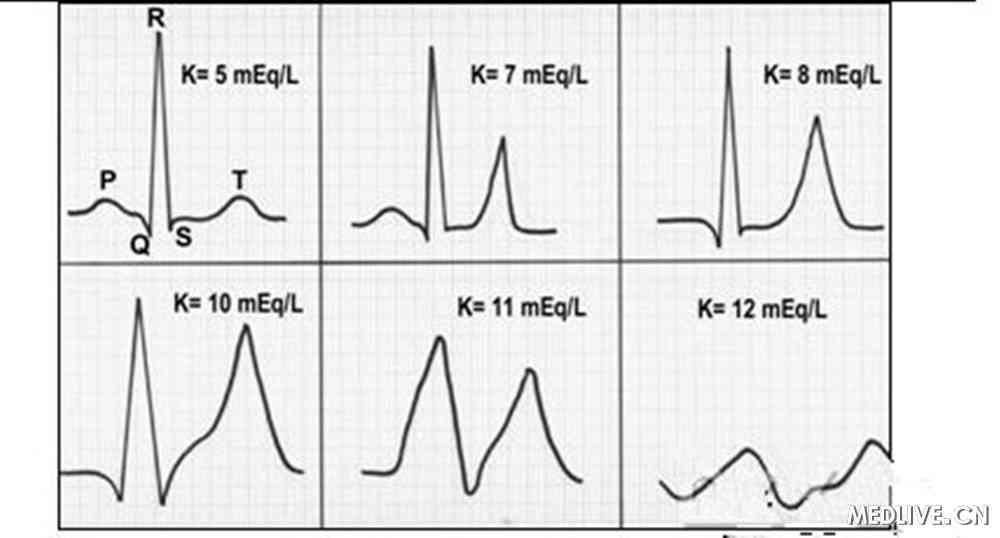 高钾血症的心电图表现