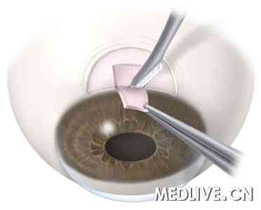 动物实验提示抗VEGF可改善青光眼手术预后_
