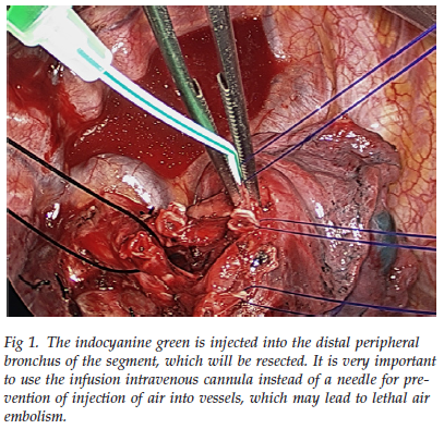 ann thorac surg:吲哚菁绿助力肺段切除术_肺癌_lung