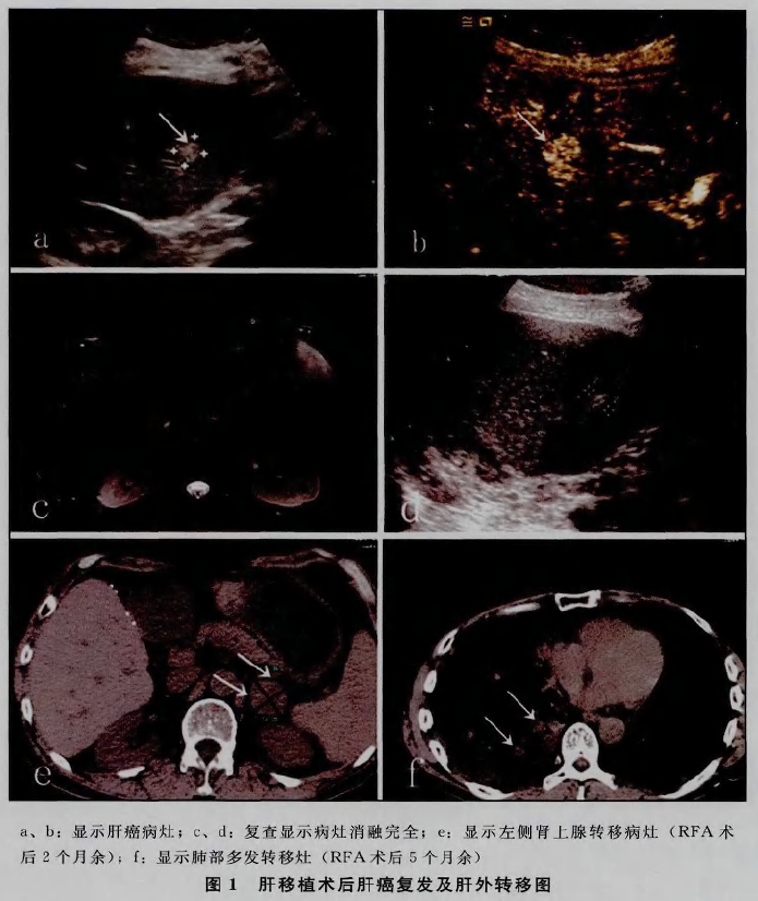 射频消融治疗肝移植术后肝癌的临床价值探讨.png