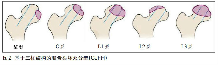 股骨头坏死分型或有"国标"