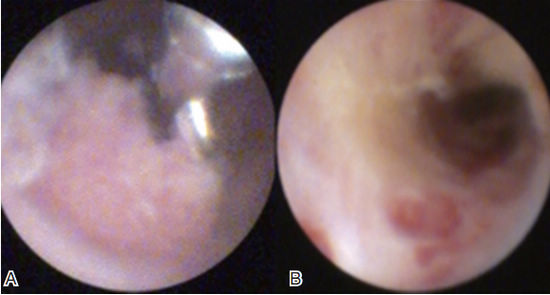 SGC下所见胆道绒毛状腺瘤
