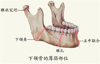 下颌骨缺损个体化修复体的应力分析与优化设计