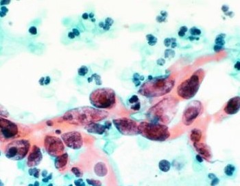 新式血浆温谱图可以诊断宫颈癌及其进展_血液