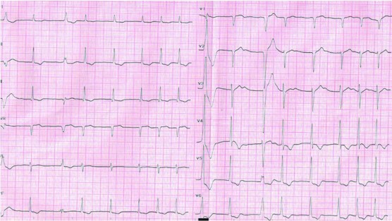 术后第5天心电图(房颤恢复,f波依然难辨,qrs波宽度80ms)
