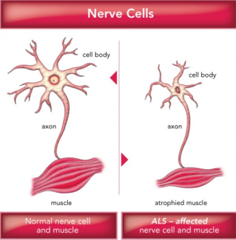 Lancet Neurol:2013神经病学总结之肌萎缩侧索硬化_肌萎缩侧索硬化_神经肌肉疾病_肌营养不良_medlive.cn