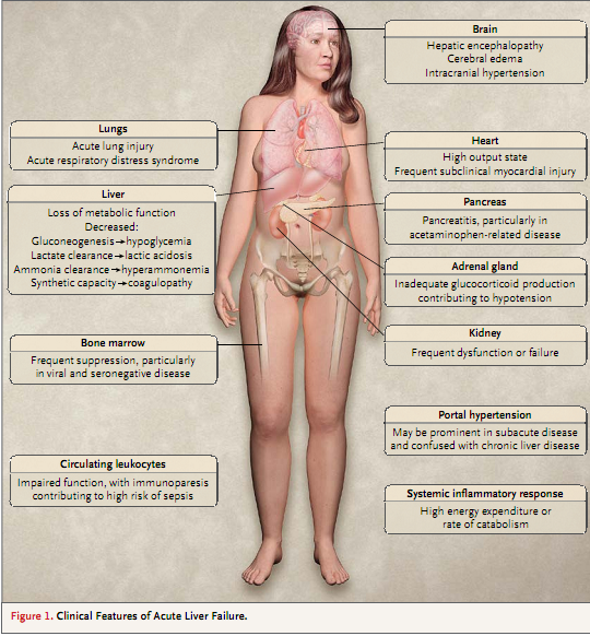 NEJM综述:急性肝功能衰竭.png