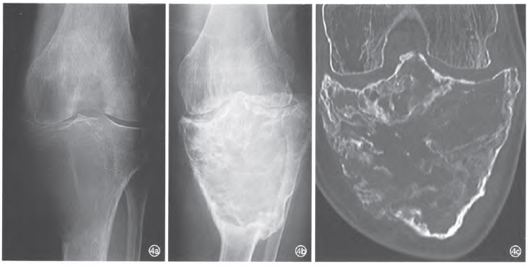 骨巨细胞瘤治疗新突破