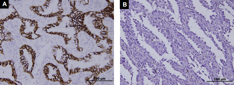 [EJC]PD-L1表达对I期肺腺癌患者预后的作用