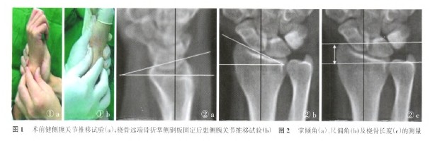 尺骨茎突骨折对下尺桡关节稳定的桡骨远端骨折术后疗效的影响