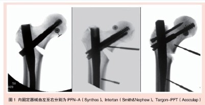 骨密度低于何值时转子间骨折髓内针固定更易失效