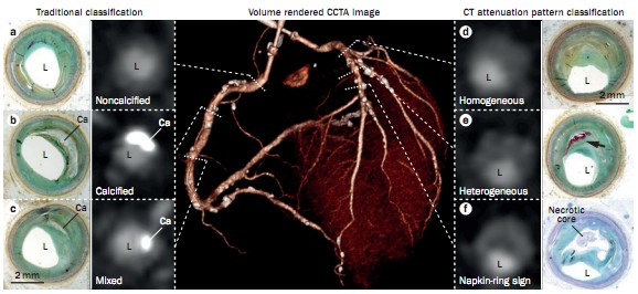 冠脉CT血管造影:餐巾环征等特征可预测易损