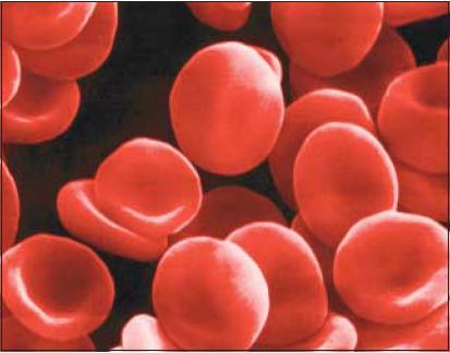 贫血时不宜单用HbA1c水平筛查糖尿病