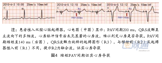 房室起搏脉冲顺序发放时,通过缩短av间期,使心室完全由起搏脉冲夺获