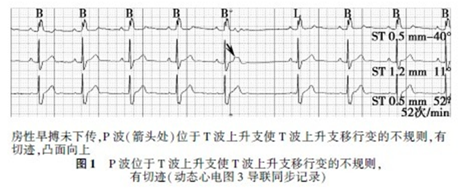 t波形态在心律失常鉴别诊断中的作用