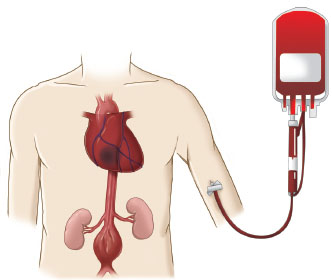 JACC:急性心肌梗死患者输血是否增加死亡风险