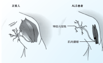 关爱“渐冻人”:不能只泼冰_肌萎缩侧索硬化_渐冻人症_冰桶挑战_医脉通