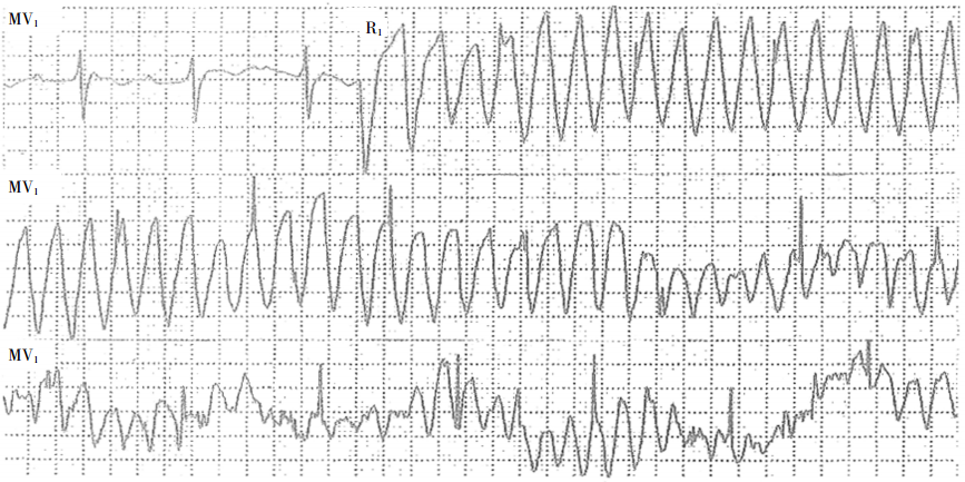 易误诊为起搏器功能异常的心电图表现_起搏器