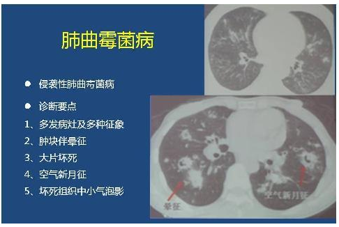 经典病例_细菌感染与真菌感染影像学的细微差别
