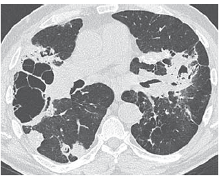 Respiration:慢性肺曲霉菌病的诊断和治疗的最