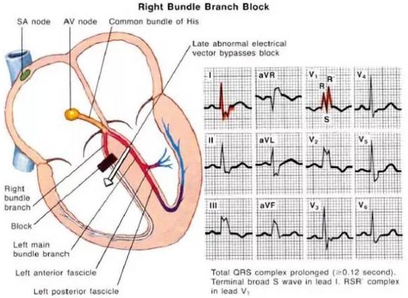 方丕华:图解老年人心律失常特点_心律失常_老