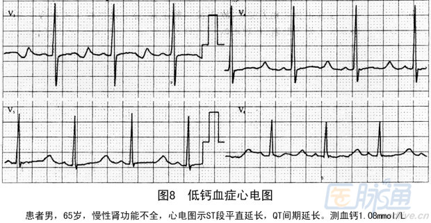 张海澄:电解质紊乱与心电图