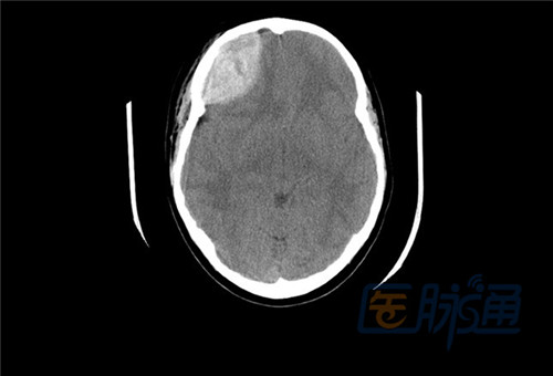 不能错过的非增强头部CT表现(图文并茂)_CT表