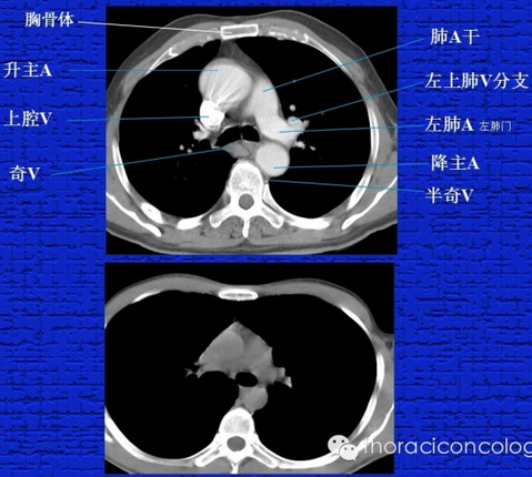 胸部正常CT解剖结构