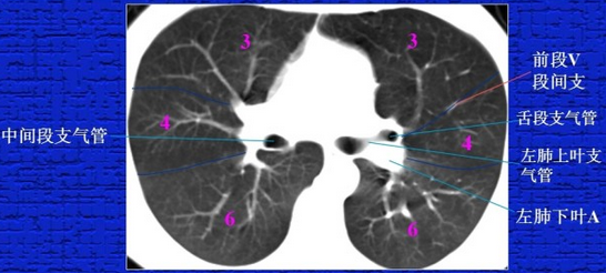 胸部正常CT解剖结构_胸部_CT_结构