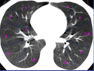 胸部正常CT解剖结构_胸部_CT_结构