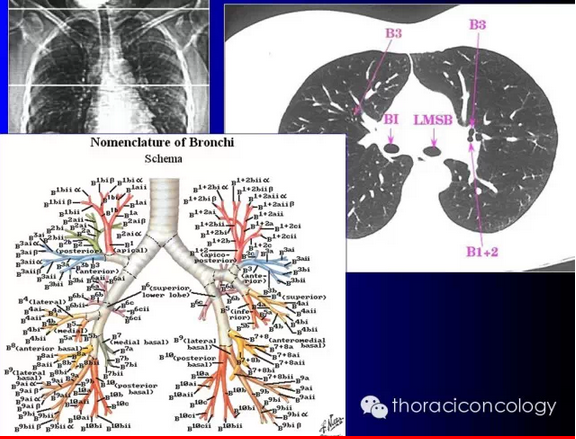 最详细的支气管解剖ct对照图