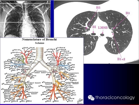 图文解读:最详细的支气管解剖ct对照图