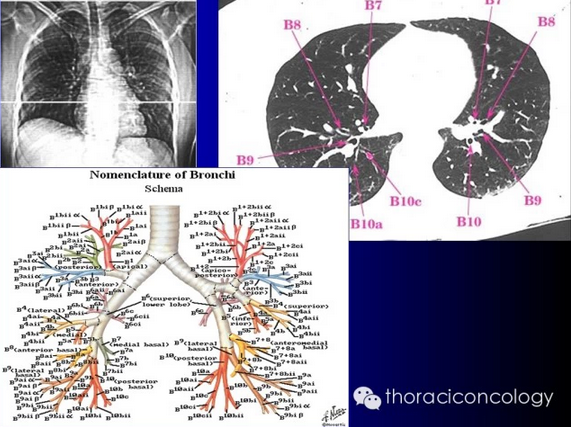 最详细的支气管解剖ct对照图