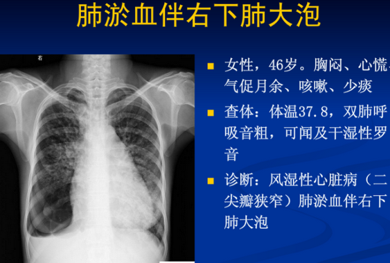 不同类型肺水肿的CT表现(上)_肺水肿_CT