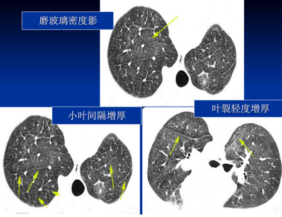 最可能的诊断:病毒性肺炎,卡氏肺孢子虫肺炎,肺出血,肺水肿,过敏性