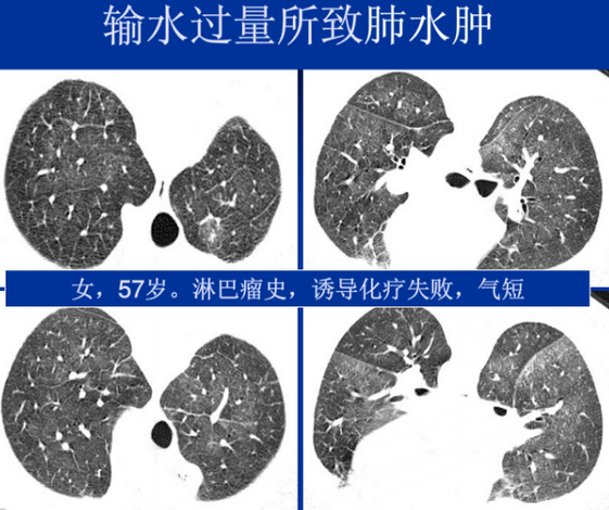 不同类型肺水肿的ct表现(上)