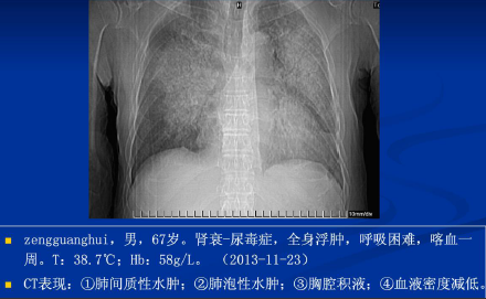 不同类型肺水肿的CT表现(下)_肺水肿_CT