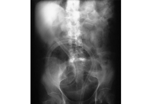 69 若干x光片了解肠道功能紊乱  x线片表现出充满整个腹部的乙状